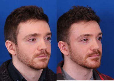 Chin Implant Before & After Gallery - Patient 297916 - Image 1
