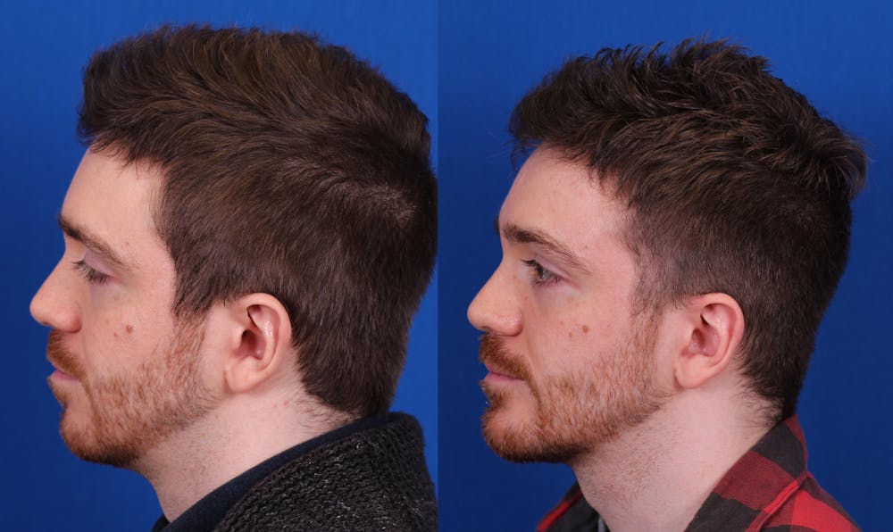 Chin Implant Before & After Gallery - Patient 297916 - Image 2