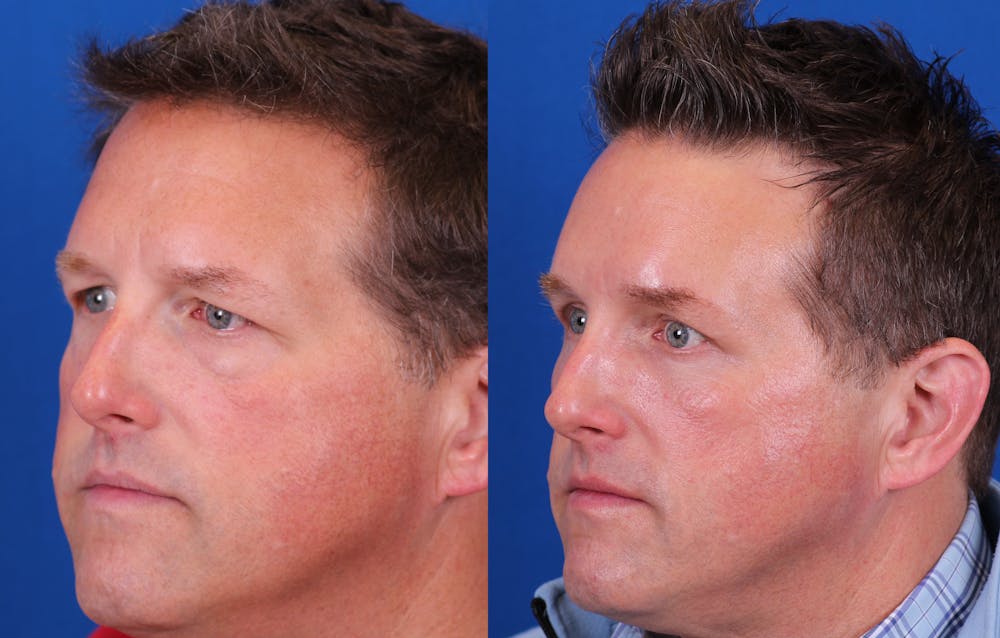 Brow Lift Before & After Gallery - Patient 172439 - Image 3