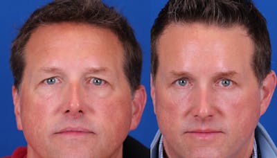 Brow Lift Before & After Gallery - Patient 172439 - Image 1