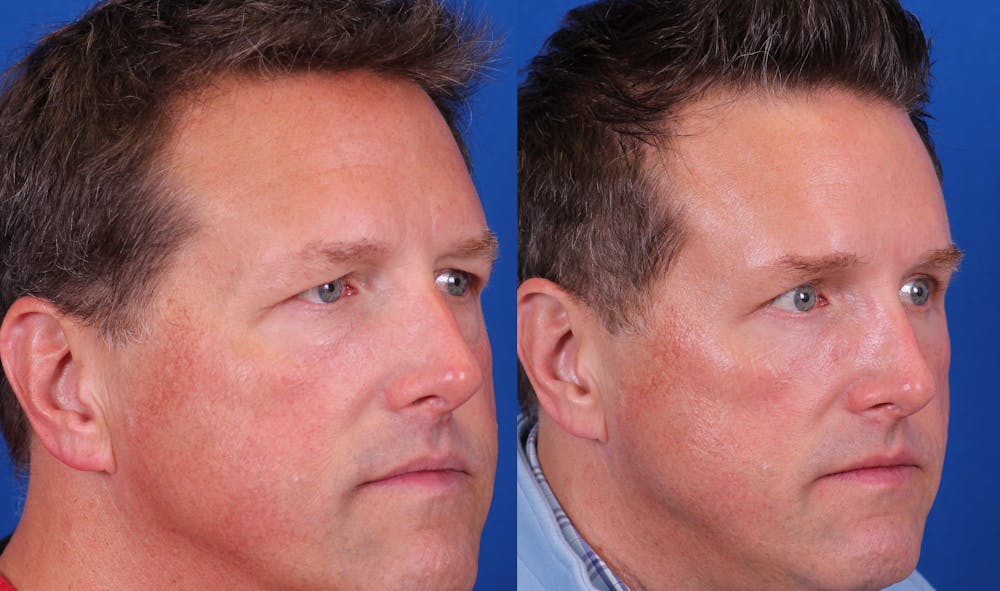 Brow Lift Before & After Gallery - Patient 172439 - Image 2