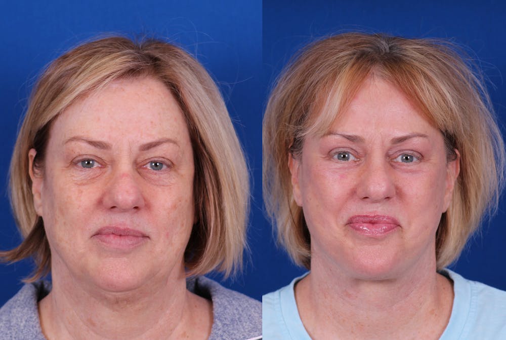 Facelift/Neck Lift Before & After Gallery - Patient 244873 - Image 1