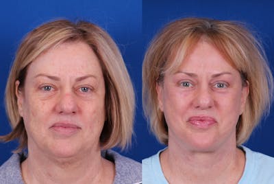 Facelift/Neck Lift Before & After Gallery - Patient 244873 - Image 1
