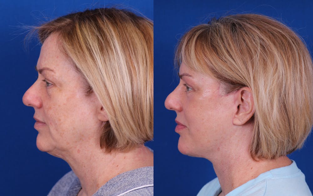 Facelift/Neck Lift Before & After Gallery - Patient 244873 - Image 3