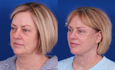 Facelift/Neck Lift Before & After Gallery - Patient 244873 - Image 2