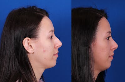 Rhinoplasty Before & After Gallery - Patient 970114 - Image 1