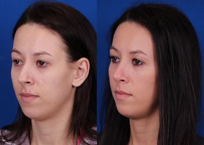 Rhinoplasty Before & After Gallery - Patient 970114 - Image 2