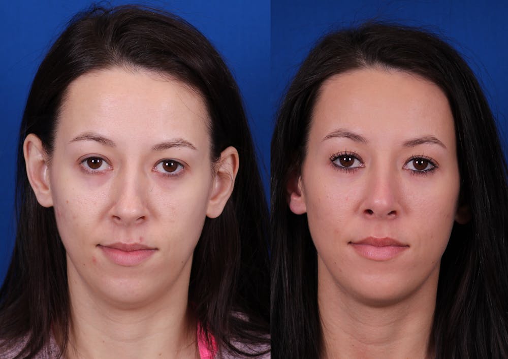 Rhinoplasty Before & After Gallery - Patient 970114 - Image 3