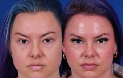 Blepharoplasty Before & After Gallery - Patient 354691 - Image 1