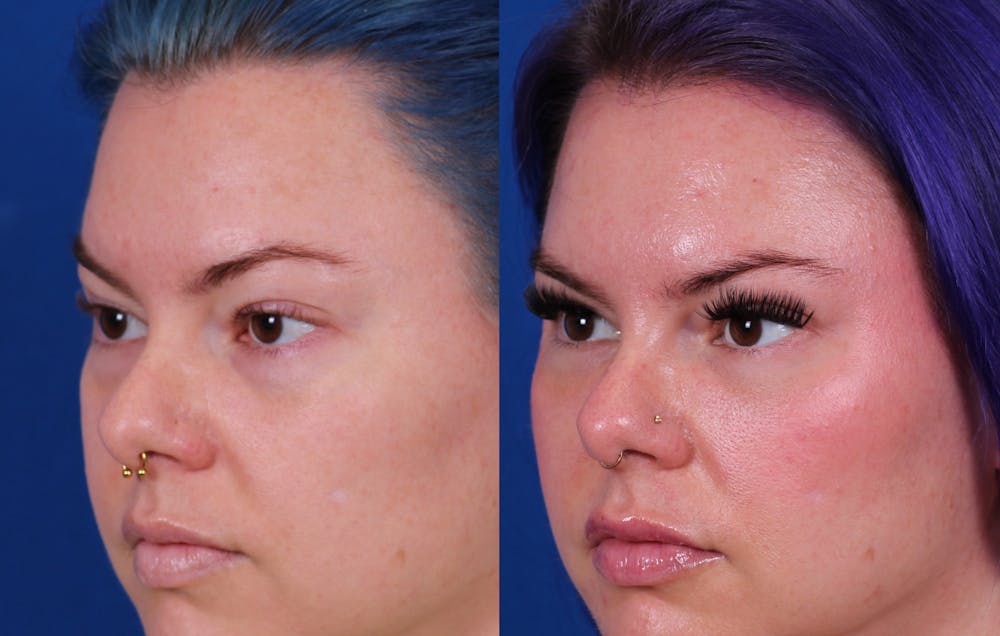 Laser Resurfacing Before & After Gallery - Patient 236114 - Image 3