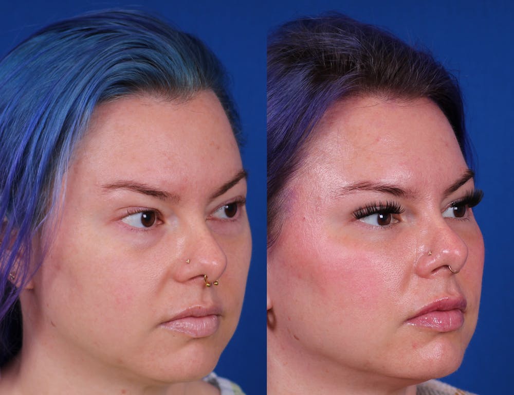 Laser Resurfacing Before & After Gallery - Patient 236114 - Image 2