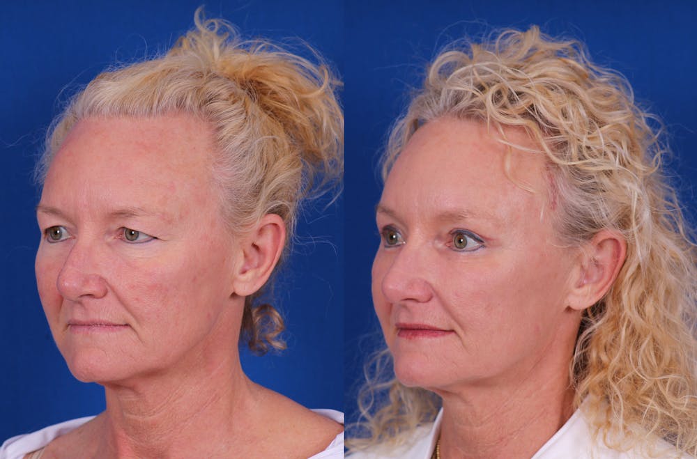 Brow Lift Before & After Gallery - Patient 298432 - Image 3