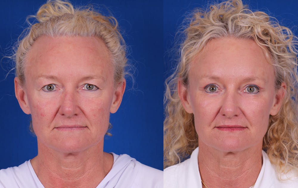 Brow Lift Before & After Gallery - Patient 298432 - Image 1