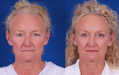 Brow Lift Before & After Gallery - Patient 298432 - Image 1