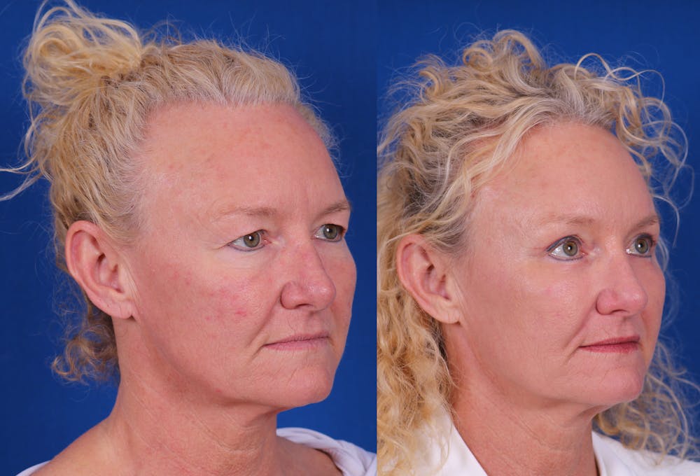 Brow Lift Before & After Gallery - Patient 298432 - Image 2