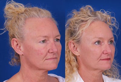 Brow Lift Before & After Gallery - Patient 298432 - Image 2