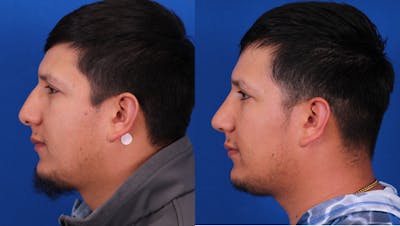 Rhinoplasty Before & After Gallery - Patient 705943 - Image 1