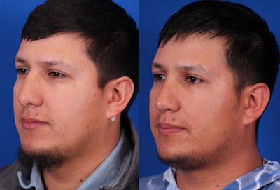 Rhinoplasty Before & After Gallery - Patient 705943 - Image 2