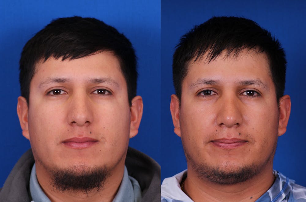 Rhinoplasty Before & After Gallery - Patient 705943 - Image 3