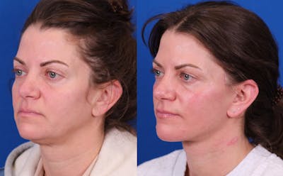 Facelift/Neck Lift Before & After Gallery - Patient 750144 - Image 2