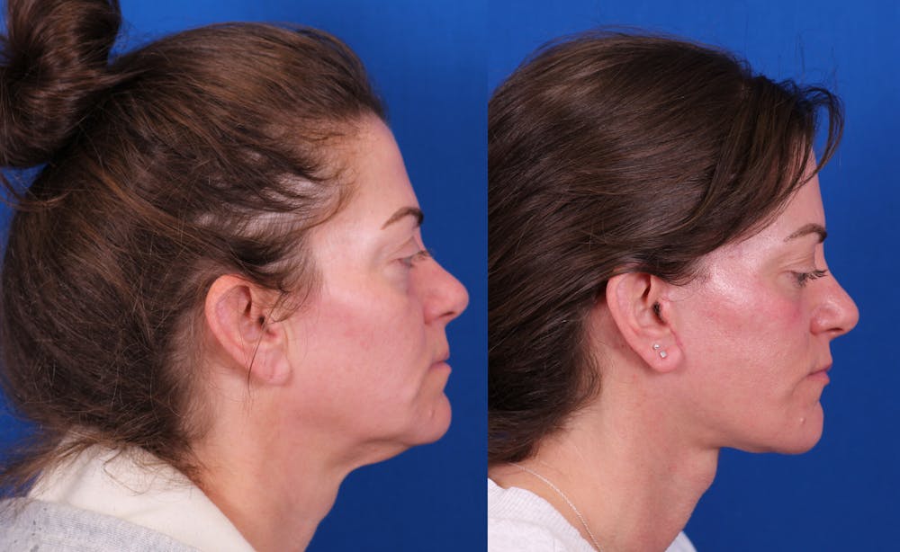 Facelift/Neck Lift Before & After Gallery - Patient 750144 - Image 3