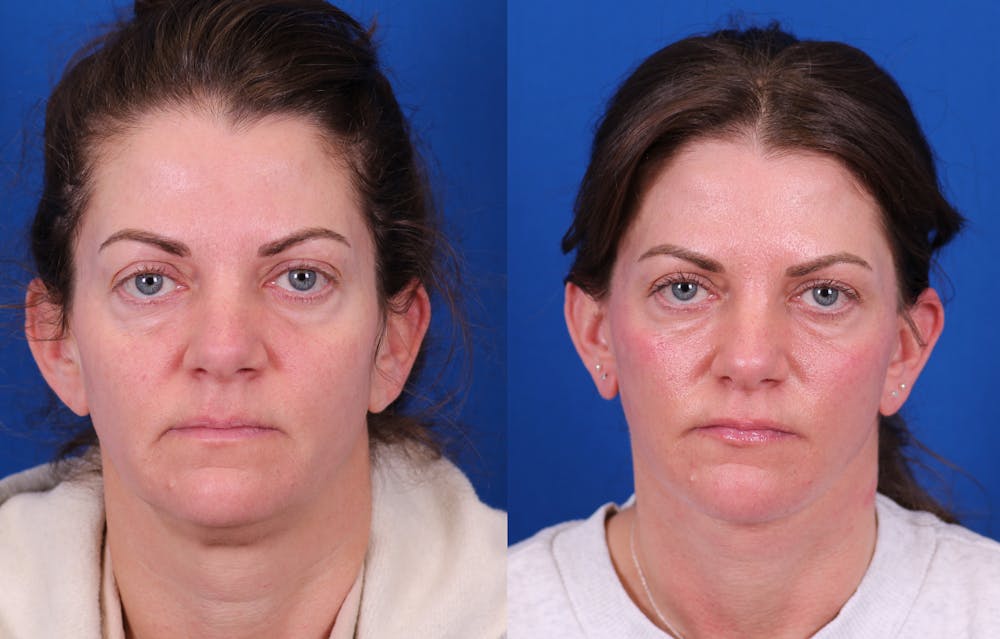 Facelift/Neck Lift Before & After Gallery - Patient 750144 - Image 1
