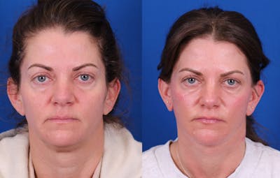 Facelift/Neck Lift Before & After Gallery - Patient 750144 - Image 1