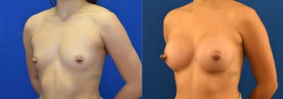 Breast Augmentation Before & After Gallery - Patient 184614 - Image 1