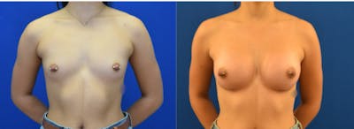 Breast Augmentation Before & After Gallery - Patient 184614 - Image 1