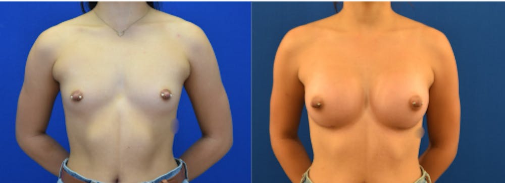 Breast Augmentation Before & After Gallery - Patient 184614 - Image 1