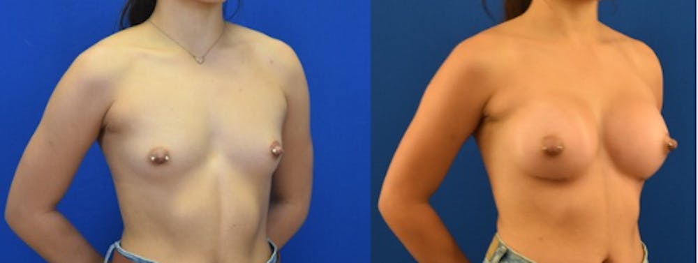 Breast Augmentation Before & After Gallery - Patient 184614 - Image 2