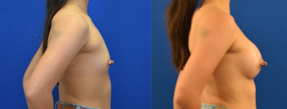 Breast Augmentation Before & After Gallery - Patient 184614 - Image 4