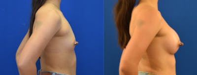 Breast Augmentation Before & After Gallery - Patient 184614 - Image 4
