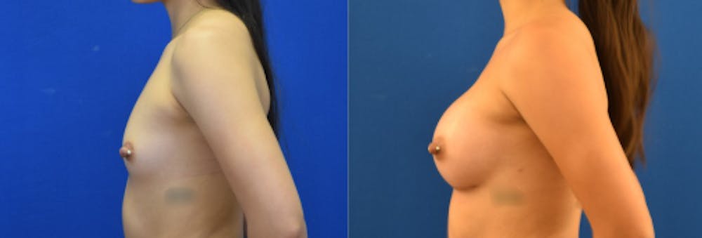 Breast Augmentation Before & After Gallery - Patient 184614 - Image 5