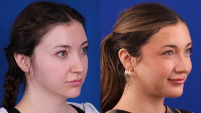 Rhinoplasty Before & After Gallery - Patient 395080 - Image 2