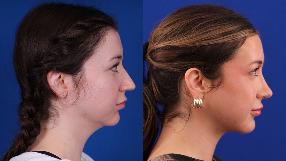 Rhinoplasty Before & After Gallery - Patient 395080 - Image 1
