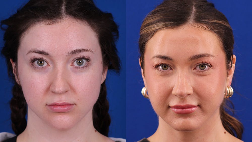 Rhinoplasty Before & After Gallery - Patient 395080 - Image 3