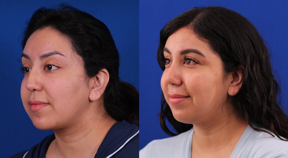 Rhinoplasty Before & After Gallery - Patient 269383 - Image 2