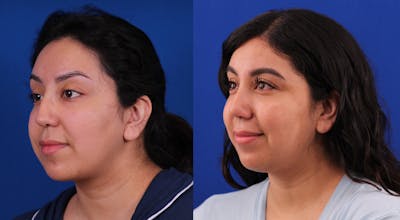 Rhinoplasty Before & After Gallery - Patient 269383 - Image 2
