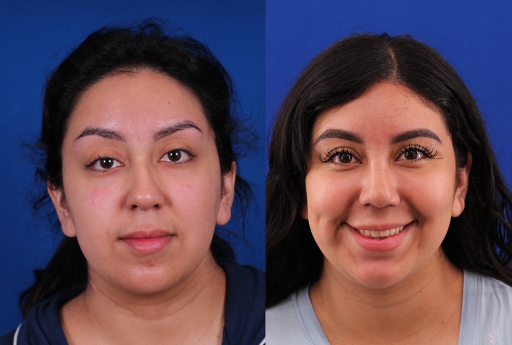 Rhinoplasty Before & After Gallery - Patient 269383 - Image 3