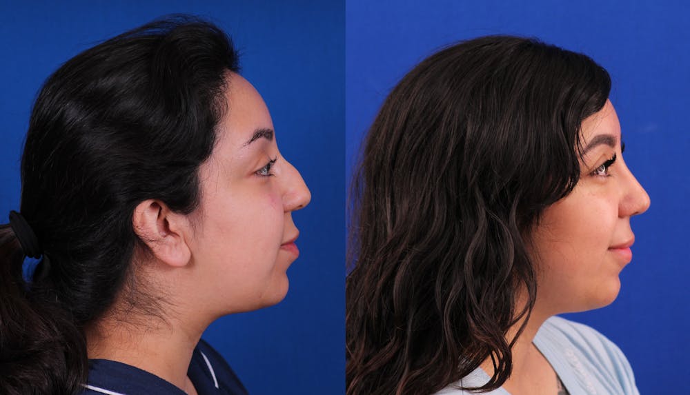 Rhinoplasty Before & After Gallery - Patient 269383 - Image 1