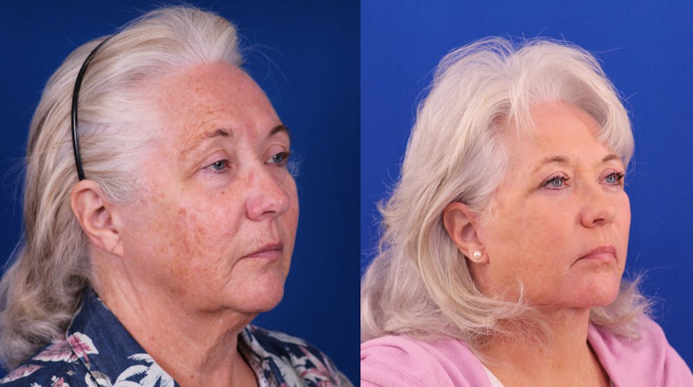 Facelift/Neck Lift Before & After Gallery - Patient 891964 - Image 2