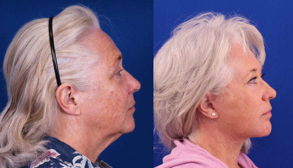Facelift/Neck Lift Before & After Gallery - Patient 891964 - Image 3