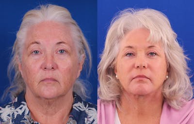 Facelift/Neck Lift Before & After Gallery - Patient 891964 - Image 1