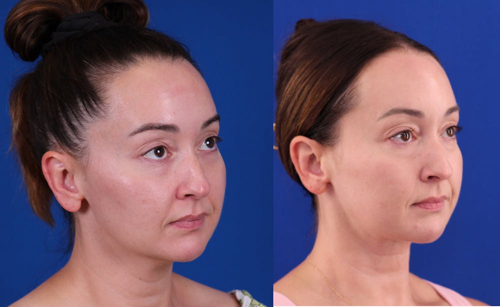 Neck deFINE Before & After Gallery - Patient 531756 - Image 2