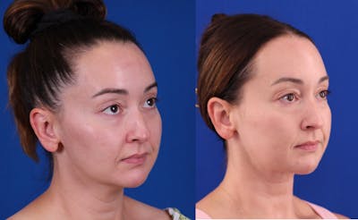 Neck deFINE Before & After Gallery - Patient 531756 - Image 2
