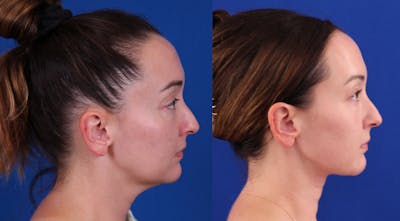 Neck deFINE Before & After Gallery - Patient 531756 - Image 1