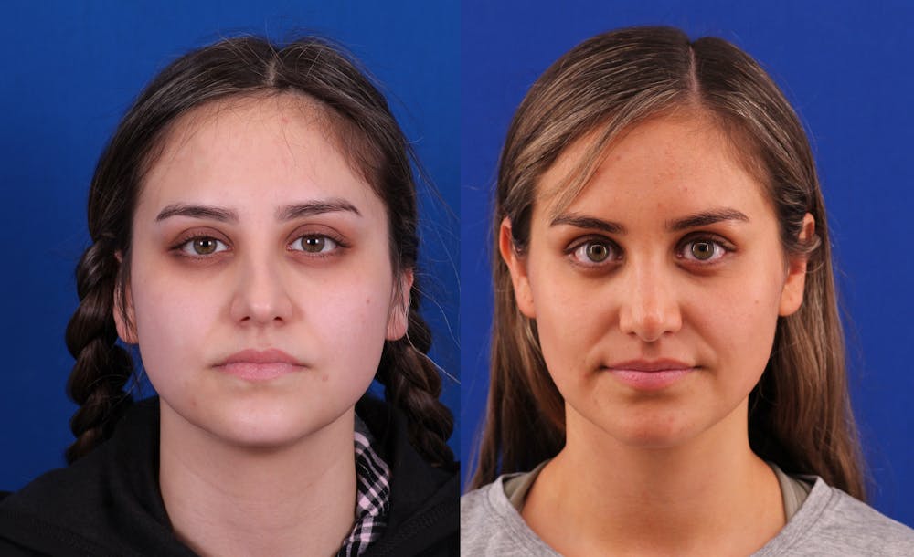 Neck deFINE Before & After Gallery - Patient 350443 - Image 3