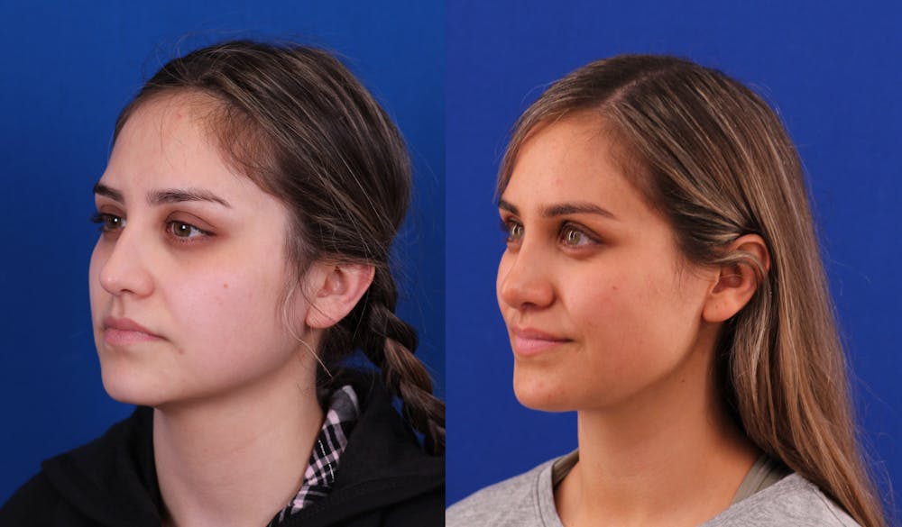 Neck deFINE Before & After Gallery - Patient 350443 - Image 2