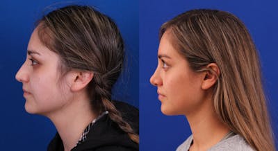 Rhinoplasty Before & After Gallery - Patient 368272 - Image 1